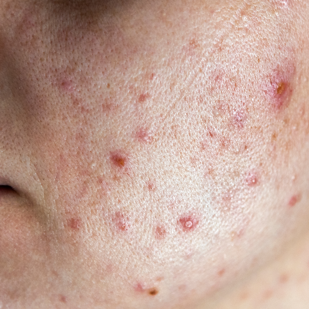 Acne & onzuiverheden